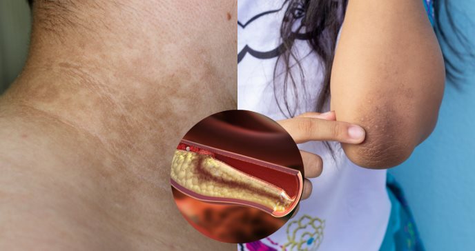 Resistencia a la insulina en adultos: qué es y cómo abordarla desde la alimentación